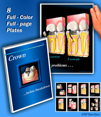 Crown... Before Breakdown Portfolio