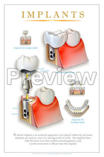 Load image into Gallery viewer, Implants Wall Chart
