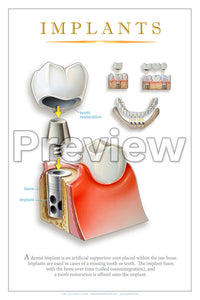 Implants #2 Wall Chart