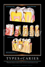 Load image into Gallery viewer, Types of Caries Wall Chart