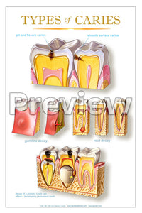 Types of Caries Wall Chart