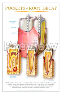 Pockets & Root Decay Wall Chart